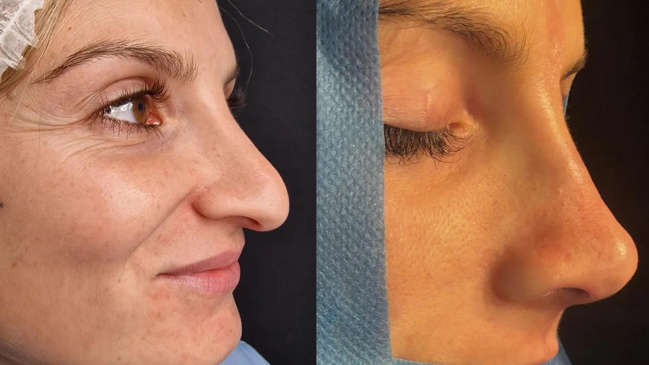 Rinoplastia femenina — antes y después