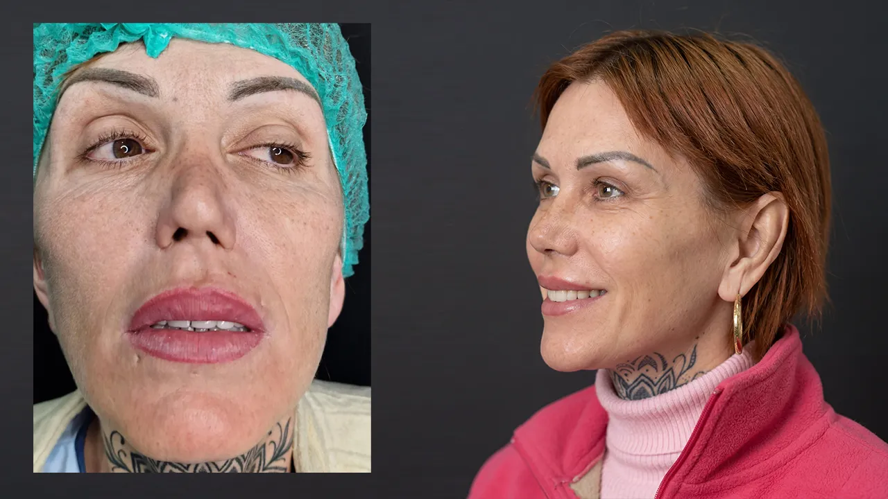 Rinoplastia secundaria — antes y después
