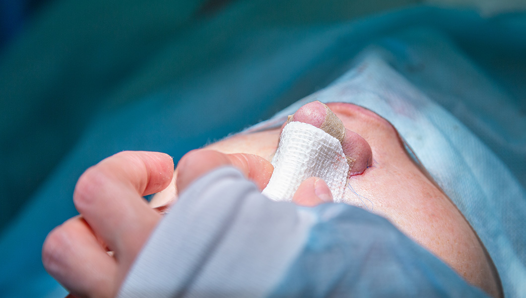 ¿Cuánto cuesta una rinoplastia?