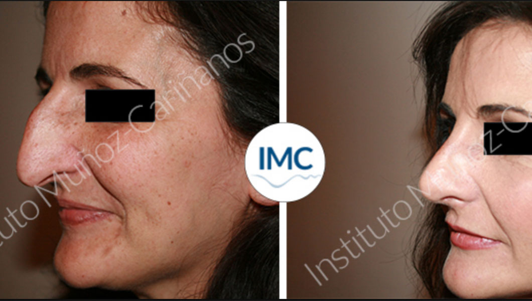 Rinoplastia: Antes y después