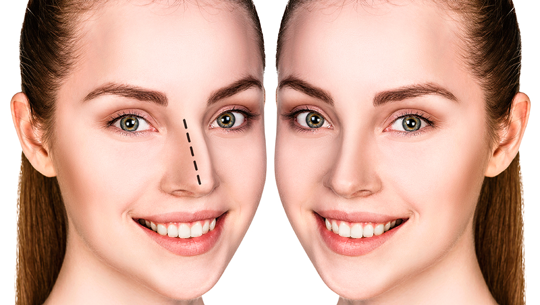 ¿A qué edad es recomendable hacerse una rinoplastia?