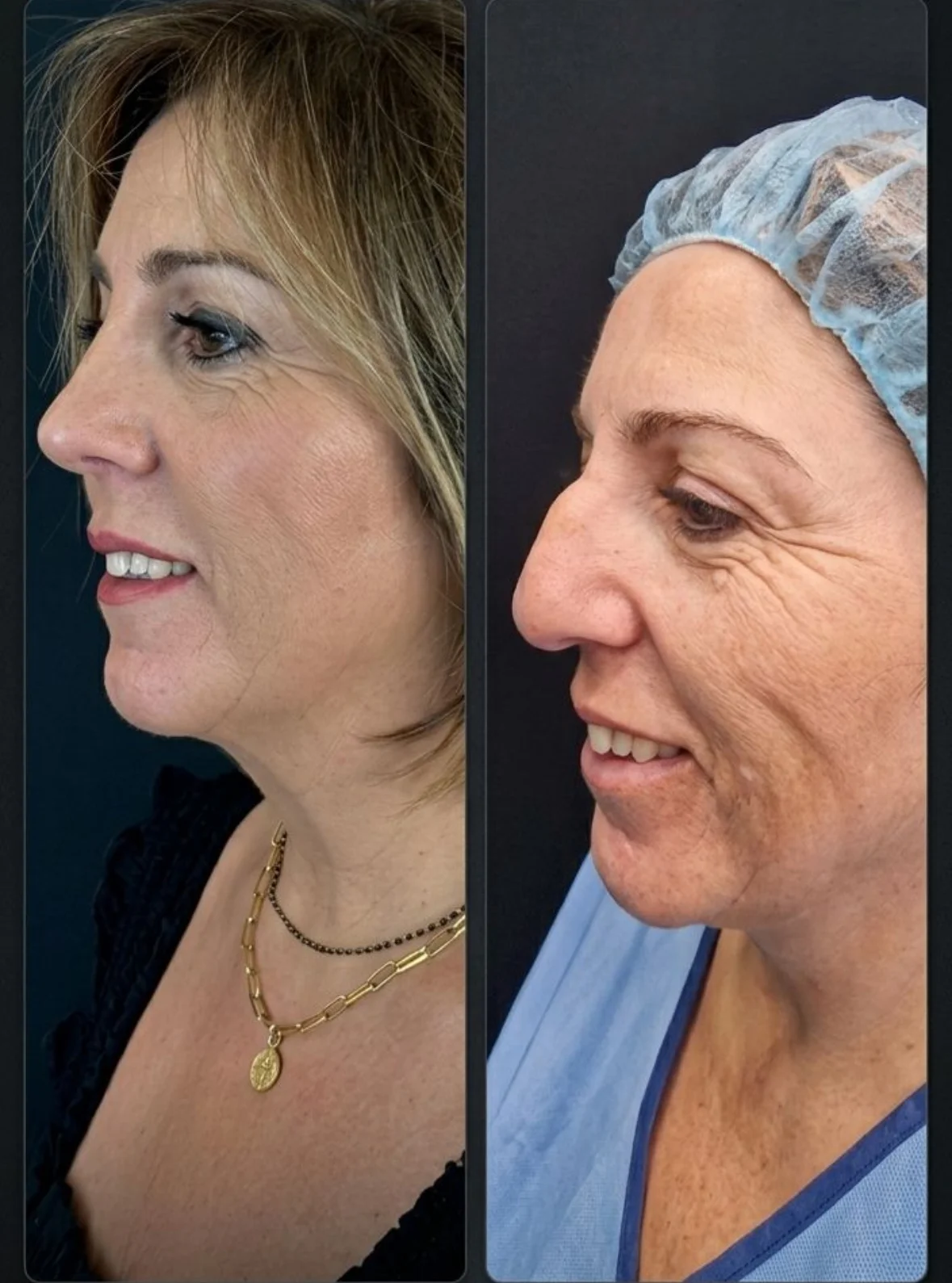 Ultrasonic Rhinoplasty in Seville: Dr. Cariñanos’s Approach to a Natural Nose Without Visible Scars