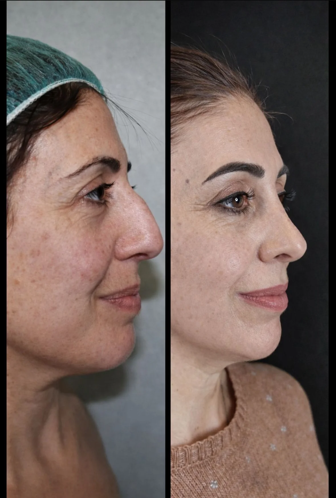 The Test of Time: How an Ultrasonic Rhinoplasty Performed Fifteen Years Ago by Dr. Cariñanos Has Aged